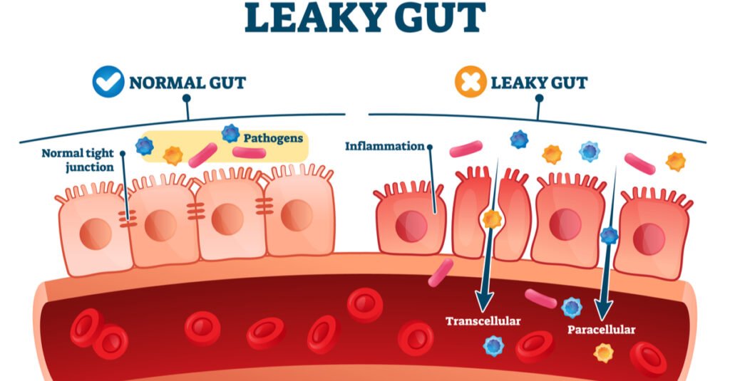 leaky gut